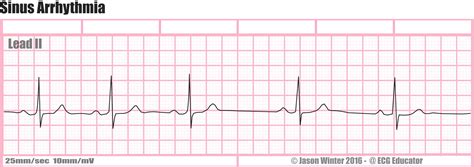 sinus arrhythmia icd 10